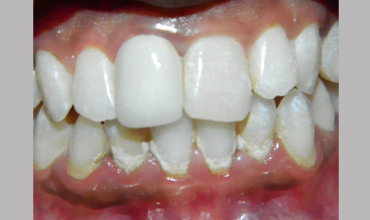 Cosmetic dentistry treatment in Anand                    